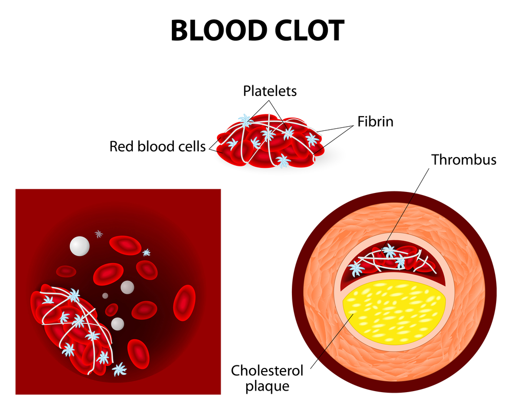 Blood Clot Treatment - Southeast Texas Cardiology - Beaumont, TX